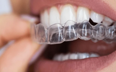 Invisalign or Clear Aligners