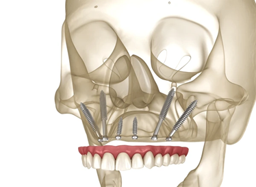 denta-implant