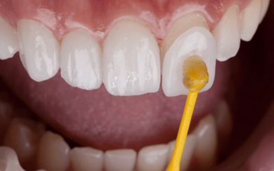 Porcelain Veneers
