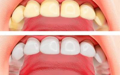 Teeth Whitening