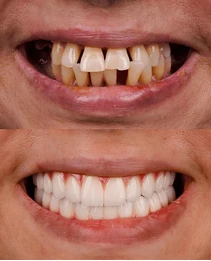 Why Choose Dr. Jaydev Dental Clinic for Invisalign in Hyderabad?