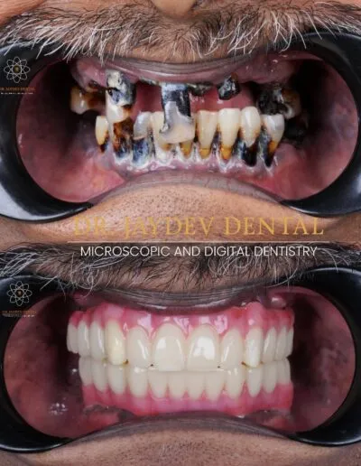 full-mouth-dental-implants-before-after