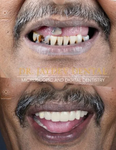 full-mouth-dental-implants-before-after