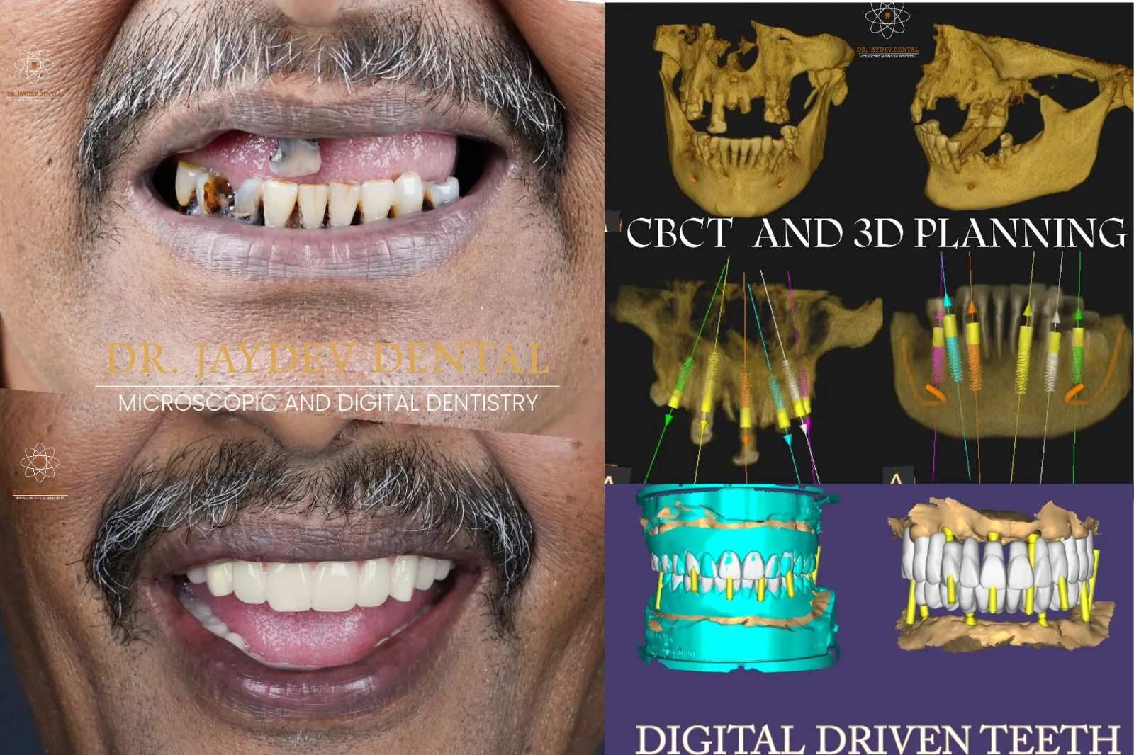 All‑on‑Six: A Fixed Full‑Mouth Solution with Just Six Implants