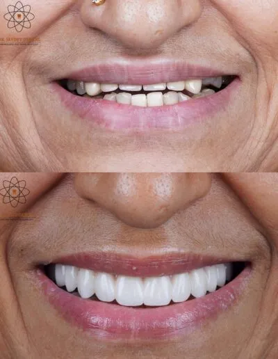 full-mouth-dental-implants-before-after