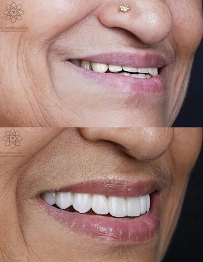 full-mouth-dental-implants-before-after