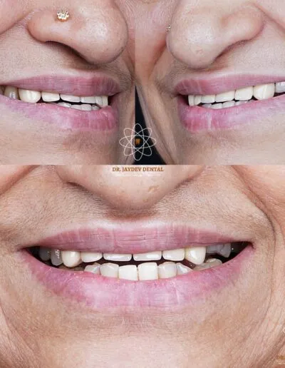 full-mouth-dental-implants-before-after