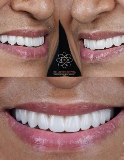 full-mouth-dental-implants-before-after
