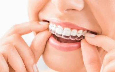 Orthodontic-Aligners | Jaydev Dental Dental Bonding