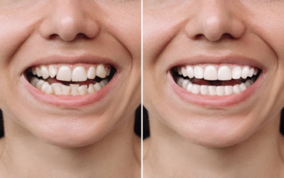 Smile Makeovers for Crooked Teeth Without Braces