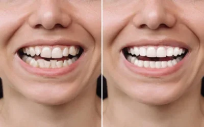 Smile Makeovers for Crooked Teeth Without Braces
