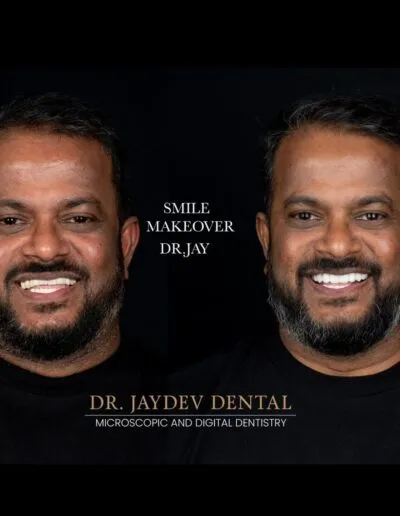 Smile-Designing-of-an-Australian-Patient