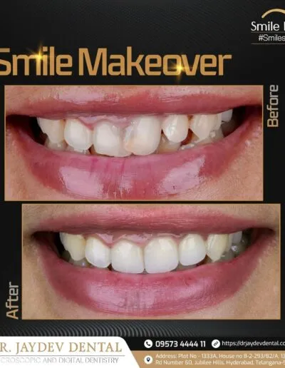 smile-makeover-before-after