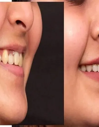 smile-makeover-before-after