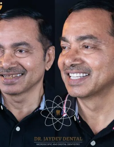 smile-makeover-before-after