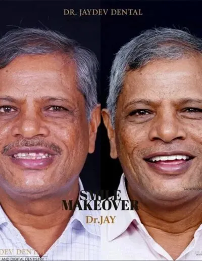 smile-makeover-before-after