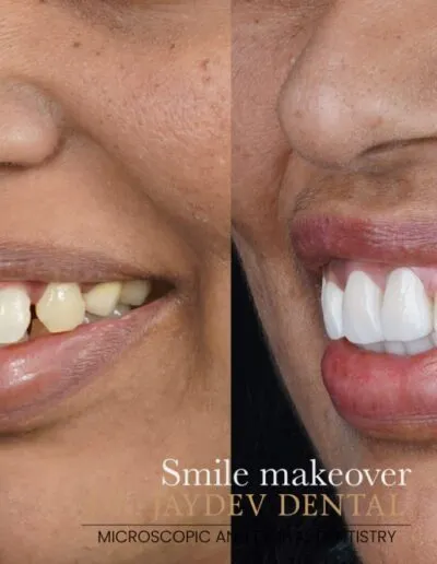 smile-makeover-before-after