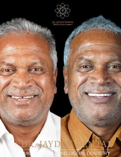 smile-makeover-before-after