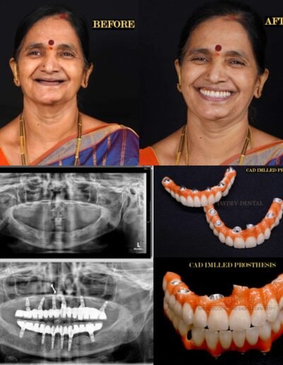 full-mouth-dental-implants-before-after