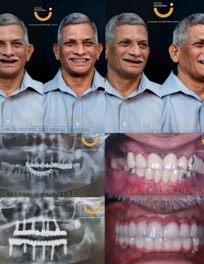 full-mouth-dental-implants-before-after