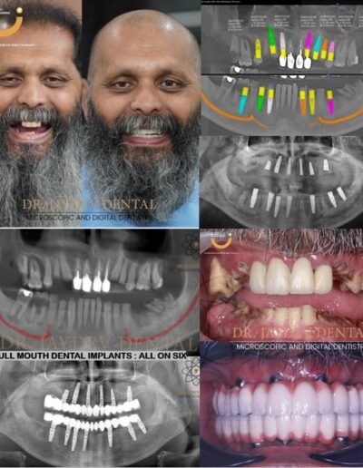full-mouth-dental-implants-before-after