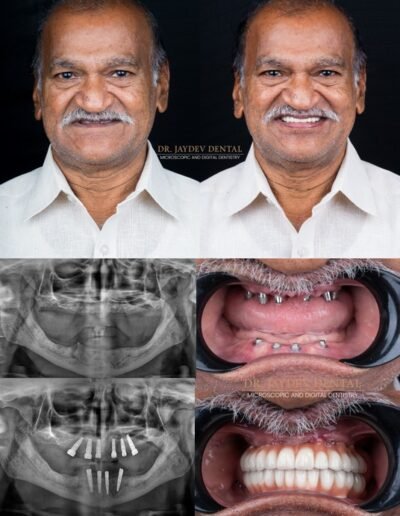 full-mouth-dental-implants-before-after