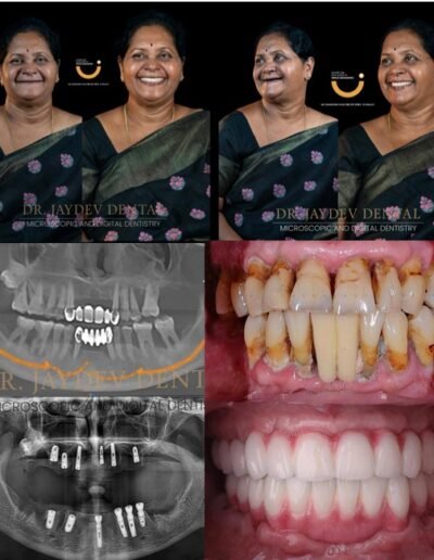 full-mouth-dental-implants-before-after