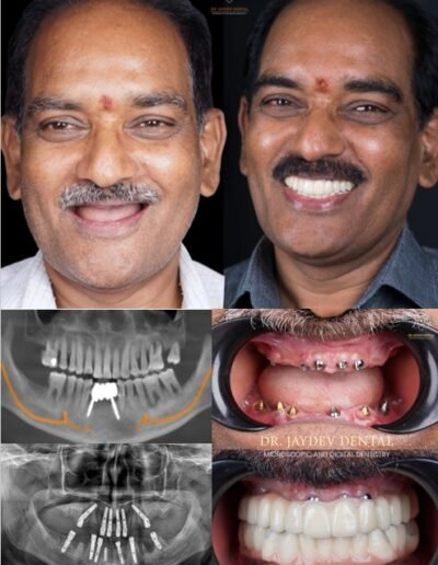 full-mouth-dental-implants-before-after