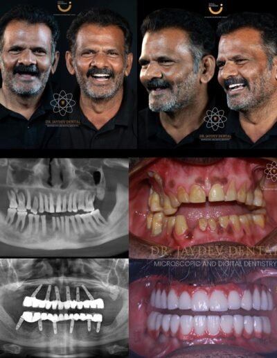 full-mouth-dental-implants-before-after