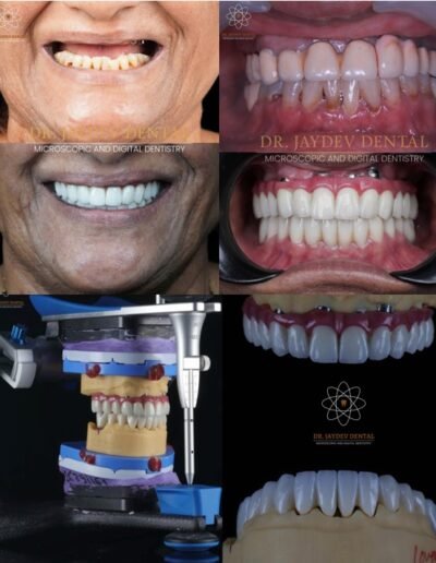 full-mouth-dental-implants-before-after