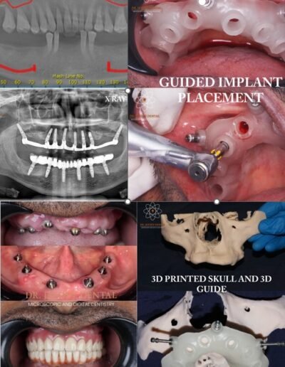 full-mouth-dental-implants-before-after