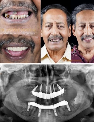full-mouth-dental-implants-before-after
