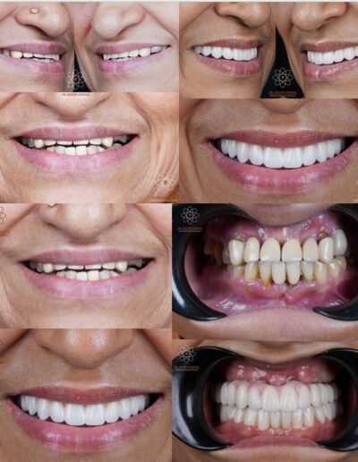 full-mouth-dental-implants-before-after