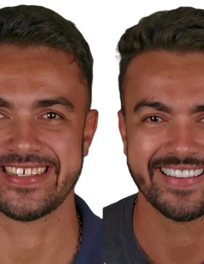 smile-makeover-before-after