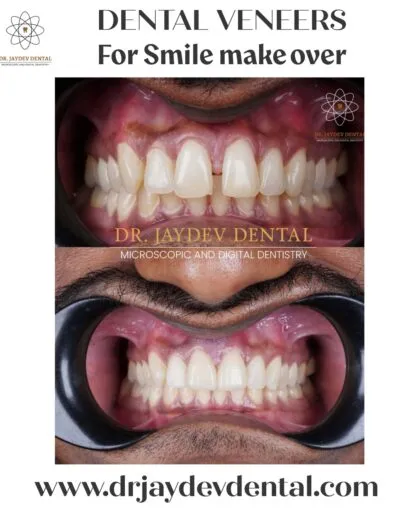 dental-veneers-for-smile-makeover-before-after