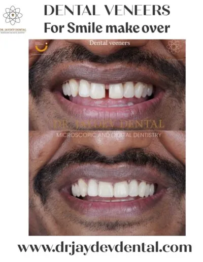 dental-veneers-for-smile-makeover-before-after