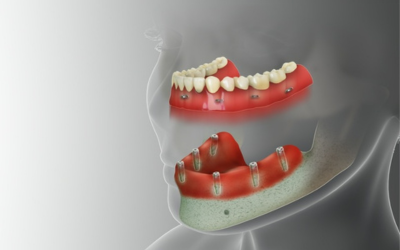 full-mouth-dental-implants