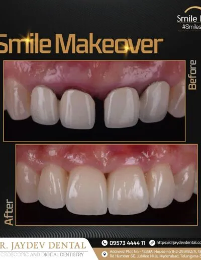 smile-makeover-before-and-after-by-Dr-Jaydev-dental-clinic