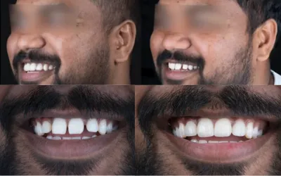 smile-makeover-before-after