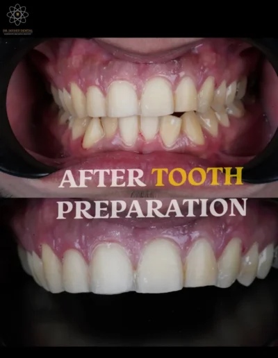 After-tooth-preparation