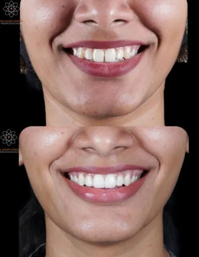Diastema-Closure-with-Porcelain-Veneers-before-after-image