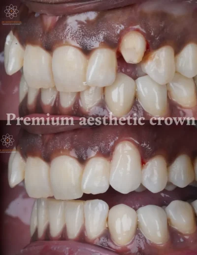 Single-Esthetic-Crown