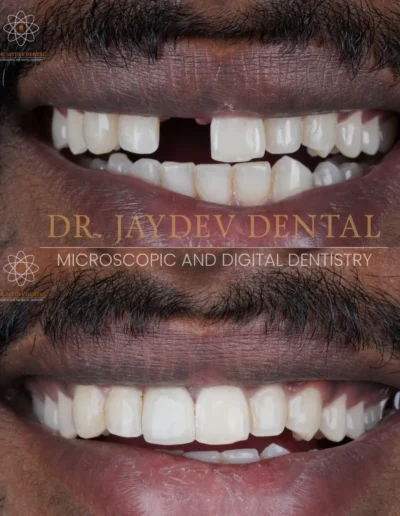 Single-Implant-Prosthesis