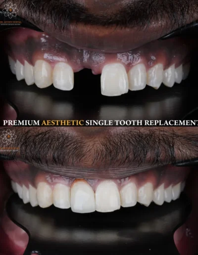 Single-Implant-Prosthesis-Before-and-after