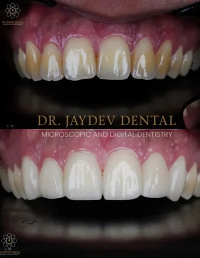 Veneers-before-after