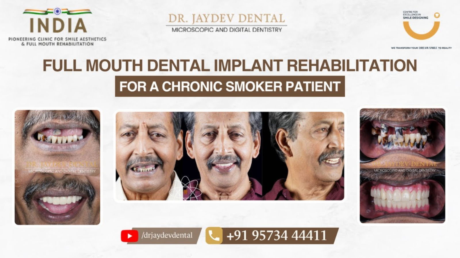 1_7 | Jaydev Dental Case-study-banner-of-All-on-6-Full-Mouth-Implants-for-Complex-Dental-Cases-in-Hyderabad