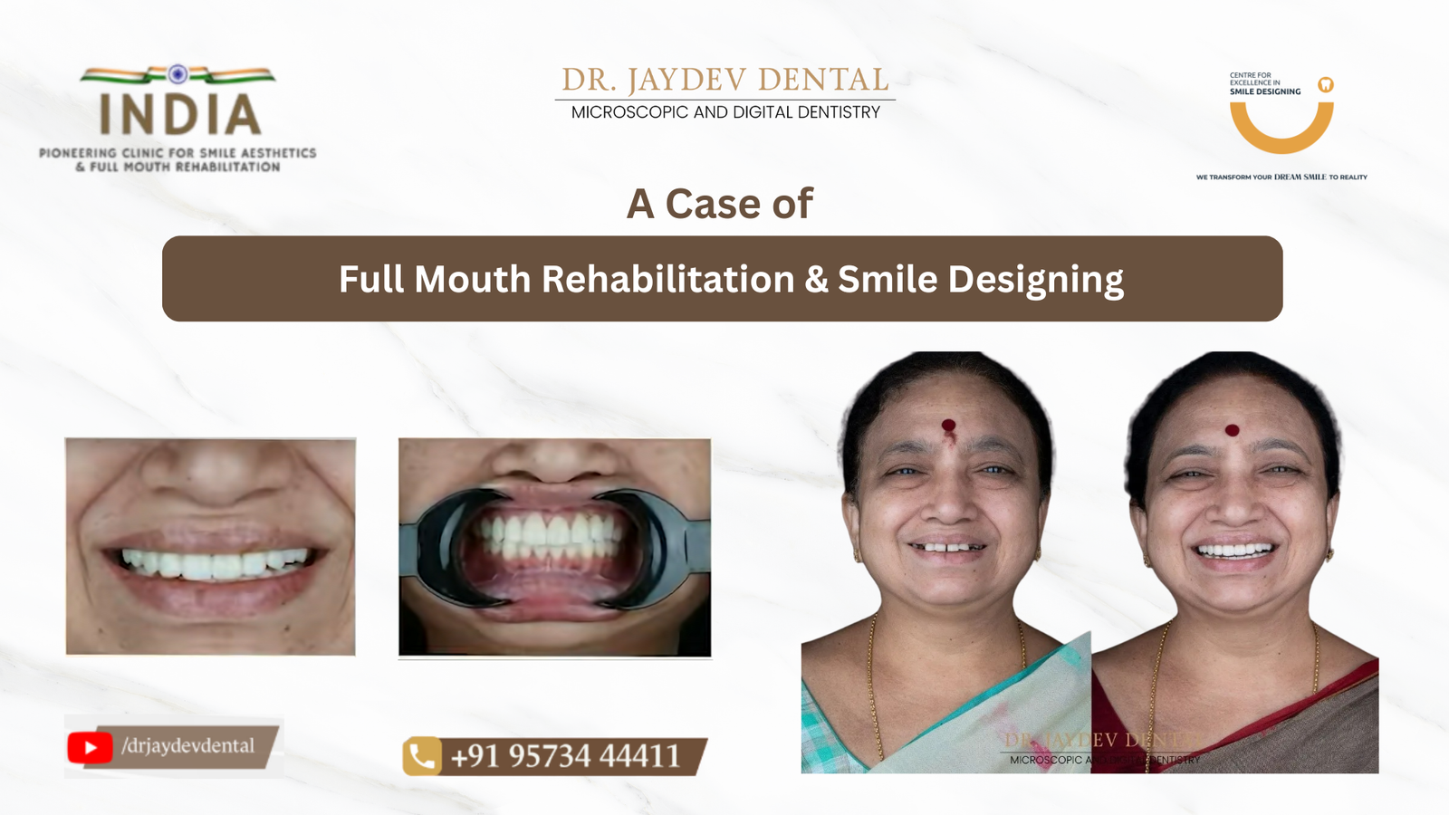 Case-study-banner-for-the case-of-full-mouth-rehabilitation-and-smile-designing | Jaydev Dental Case-study-banner-for-the case-of-full-mouth-rehabilitation-and-smile-designing