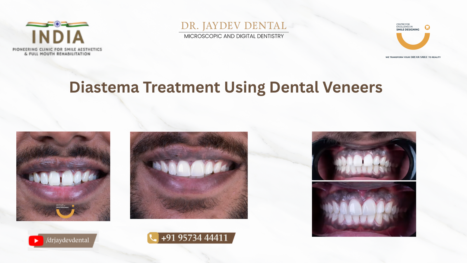 Case-study-banner-image-Diastema-Treatment-Using-Dental-Veneers