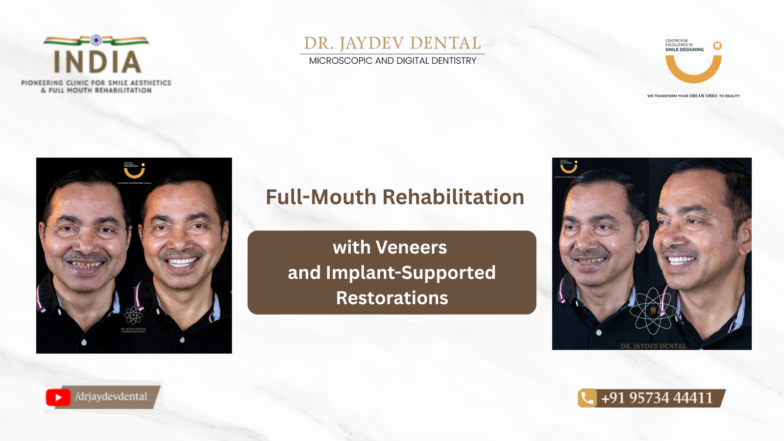 case-study-banner-image-Full-Mouth-Rehabilitation-with-Veneers-and-Implant-Supported-Restorations | Jaydev Dental case-study-banner-image-Full-Mouth-Rehabilitation-with-Veneers-and-Implant-Supported-Restorations