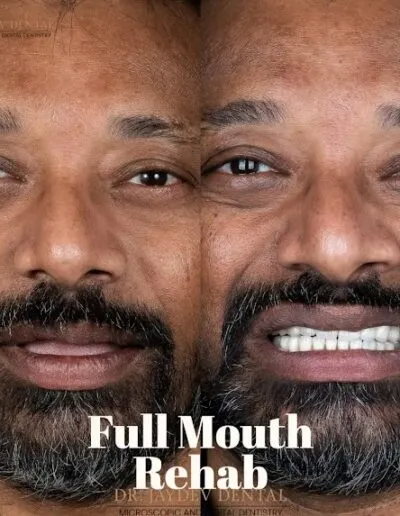 full-mouth-rehab-before-after